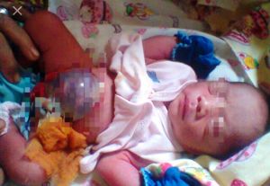 Memprihatinkan, Bayi Asal Singkut Ini Lahir Tanpa Kulit Perut  Kini Dirawat di RUSD Raden Mataher