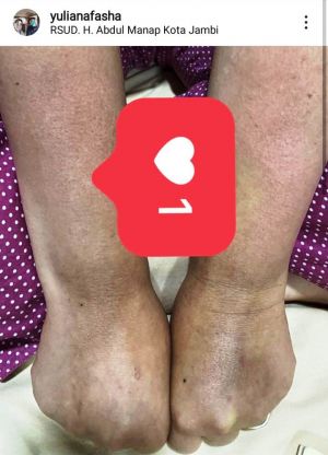 Tangannya Menghitam Karena Antibiotik, Yuliana Fasha Ingatkan Warga Tak Remehkan Covid-19